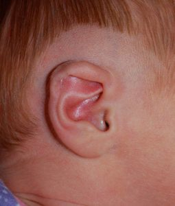 earwell infant ear mold